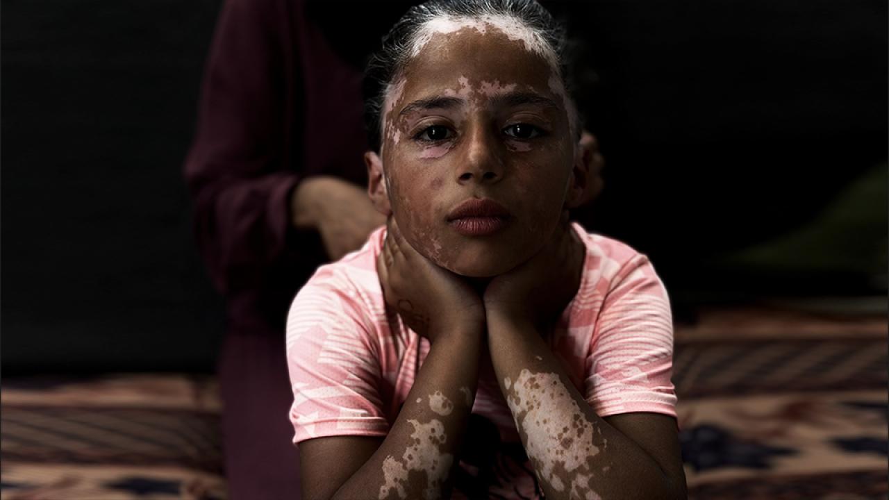 vitiligo-gazze-a-2359471.jpg